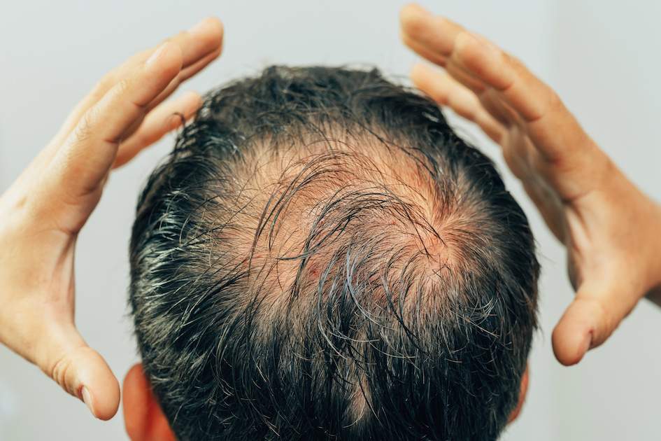 Kopfhaut-Peeling gehört zur ganzheitlichen Therapie der Kopfhaut bei Haarausfall