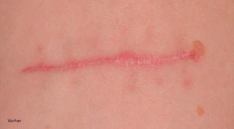 Narbenbild vor der Behandlung mit dem Narben Serum von Utsukusy Cosmetics