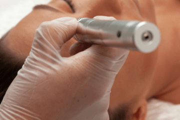 Erfahrungen mit Microneedling |Microneedling-Pen | Derma-Pen |
